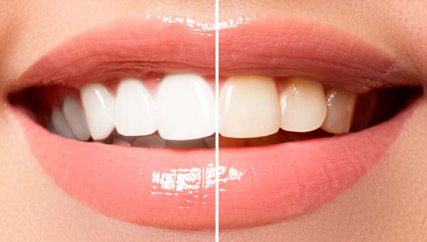 Как эффективно и быстро отбелить зубы в домашних условиях без вреда